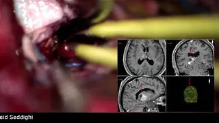 Microsurgical Resection of Thalamic Cavernoma