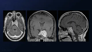 Pterional Craniotomy and Anterior Clinoidectomy for Resection of a Cavernous Sinus Meningioma