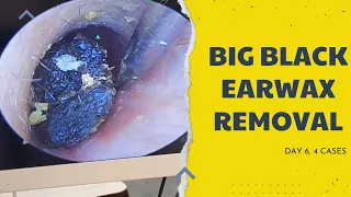 Big black earwax removal|Day 6| Earwax Removal|Doctor Earwax|