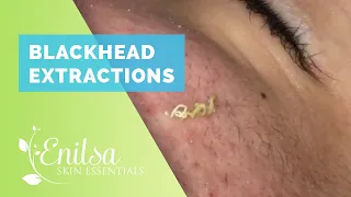 Blackhead Extractions on “K” #9