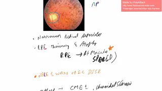 RETINITIS PIGMENTOSA ( Pathology, Types, Optic disk changes, ERG, Treatment )