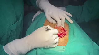 Pfannensteil incision for cesarean section