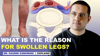 Swollen feet | Ankle swelling | Leg swelling | May Thurner syndrome | Dr. Gaurav Gangwani