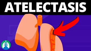 Atelectasis (Medical Definition) | Quick Explainer Video