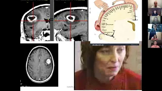 Medical Student Lecture Series - Brain Tumors