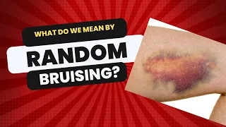 What do we mean by Random Bruising?