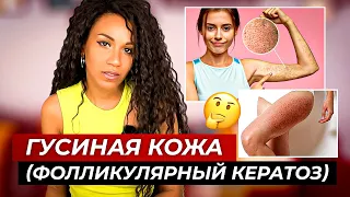 ГУСИНАЯ КОЖА // Фолликулярный кератоз: простые рекомендации  как сделать кожу гладкой