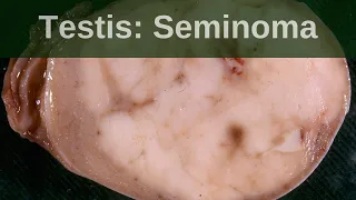 Testicular germ cell tumours  -  Seminoma - Pathology mini tutorial