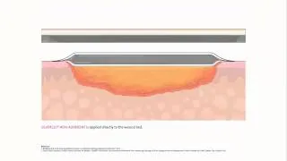 SILVERCEL™ NON-ADHERENT Antimicrobial Alginate Dressing with EasyLIFT™ Precision Film Technology