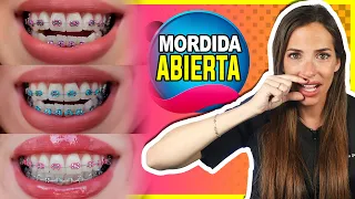 🔴 𝗠𝗢𝗥𝗗𝗜𝗗𝗔 𝗔𝗕𝗜𝗘𝗥𝗧𝗔 Ortodoncia : Mis dientes de arriba no tocan los de abajo (💊 Así SE CORRIGE)