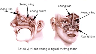 (VTC14)_ Bài thuốc dân gian điều trị bệnh viêm xoang