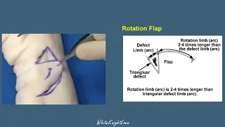 8 3 Rotation Flap  Skin Flaps   Essential Surgical Skills WhiteKnightLove