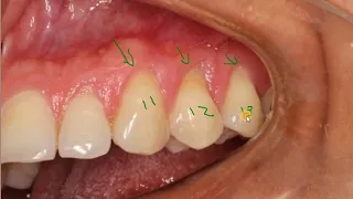 Dentinal Hypersensitivity - Screencast