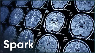 What Happens To The Brain In Old Age? | The Brain Fitness Program | Spark