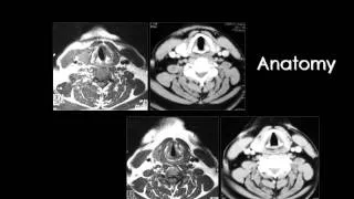 Radiology - Imaging of Larynx - Head and Neck