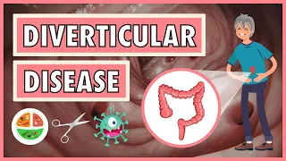 Diverticular Disease | Emphasis on Diet/Nutrition