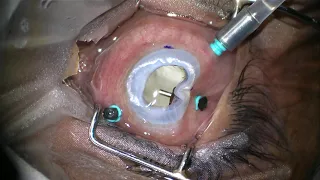 AIOC2021 - VT160 - Temporary Keratoprosthesis Assisted Vitrectomy with Impaling of Br..