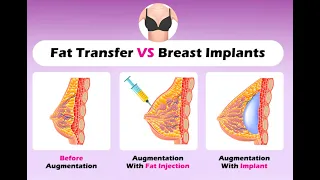 Breast Augmentation - Implants VS Fat Transfer (Answered!)