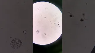 White blood cells vs Red blood cells in urine #laboratory #mls #microscope #medtechstudent #urine