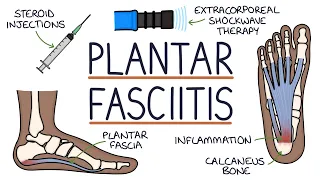 Understanding Plantar Fasciitis