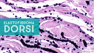 Elastofibroma Dorsi 101...Explained by a Soft Tissue Pathologist