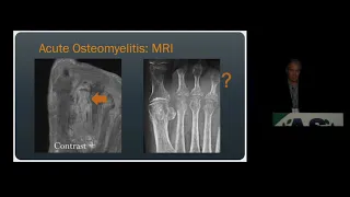 Imaging of Osteomyelitis & Septic Arthritis | 15 Minute Radiology CME