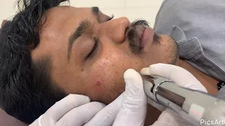 Microneedling Treatment For Chicken Pox Scar Marks On Skin by Dr. Vaseem Choudhary
