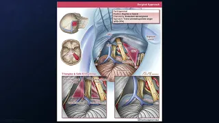 Extended Retrosigmoid Craniotomy for Cavernous Malformation of Facial-Vestibulocochlear Nerve Bundle