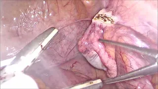 orchidectomy by laparoscope Dr Haider ALRamahiرفع الخصى د.حيدر علي الرماحي