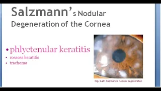 Ophthalmology Salzmann nodular degeneration of cornea phlyctenular rosacea keratitis trachoma