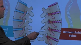 Anatomy of Spine: Osteoarthritis