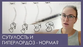 Сутулость и гиперлордоз, в каких случаях не нужно ничего делать?