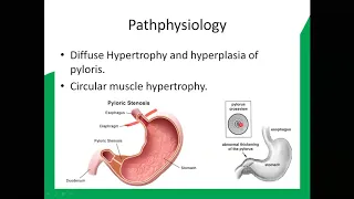 Hypertrophic Pyloric Stenosis part1 21 Aug 20