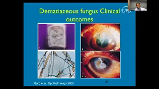 Lecture: Fungal Keratitis