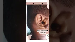 SAFE Ear Tag Removal | Easy Steps to Remove Pre-Auricular #skintags  #skintagsremoval #shorts