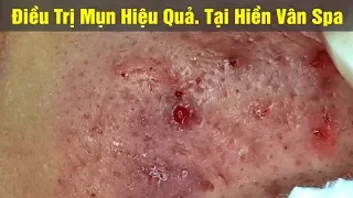 Cách điều trị mụn viêm, mụn bọc hiệu quả | Duy Phương | part 6. Tại Hiền Vân Spa - bài 259