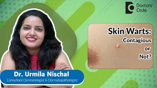 SKIN WARTS- Everything you need to know  #warts #skin  - Dr. Urmila Nischal | Doctors' Circle