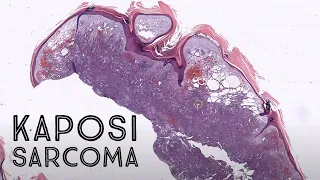 Kaposi sarcoma, nodular/tumor stage (HHV-8 HIV AIDS pathology dermpath dermatology)