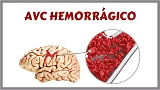 Acidente Vascular Cerebral Hemorrágico - AVCH