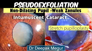 Phacoemulsification -Pseudoexfoliation,Poor Mydriasis, Weak Zonules, Intumescent Cataract, Dr Megur