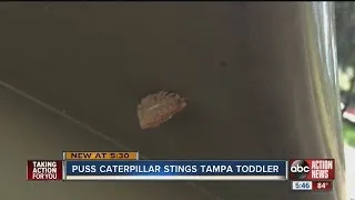 Puss caterpillar stings Tampa toddler