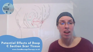 C Section - Potential Effects of Deep Scar Tissue