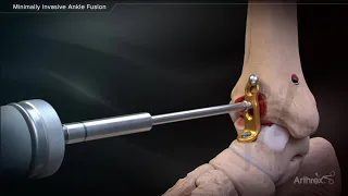 Minimally Invasive Ankle Fusion