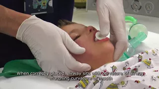Paediatric Anaesthetics: Chapter 1 - Mask anaesthesia after iv induction
