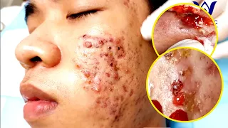 Điều trị mụn hiệu quả tại TPHCM | Hiền Vân Spa Clinic | Hiền Vân Spa | Acne Treatment|715