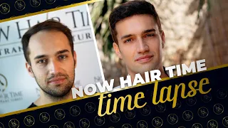 Hair Transplant Results with 4400 Grafts (Result of 8 Months)