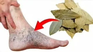 Say Goodbye To Varicose Veins | Joint Pain With Bay Leaf Only | 100% Effective