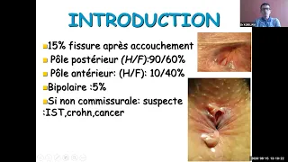 38 et 39. Fissures et suppurations anales (Dr KORDJANI)