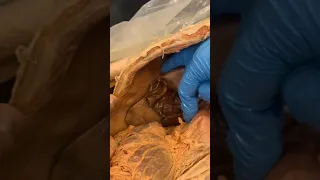 REAL Human Gallbladder