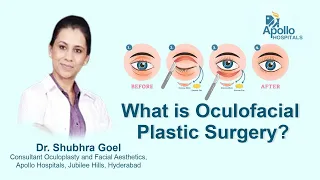 What is Oculofacial Plastic Surgery ? Dr. Shubhra Goel, Consultant Oculoplastic & Facial Aesthetics